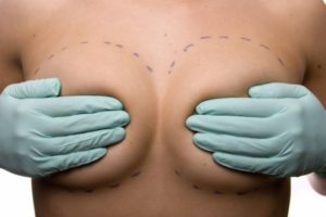 Cómo prepararse para la recuperación de la reducción mamaria