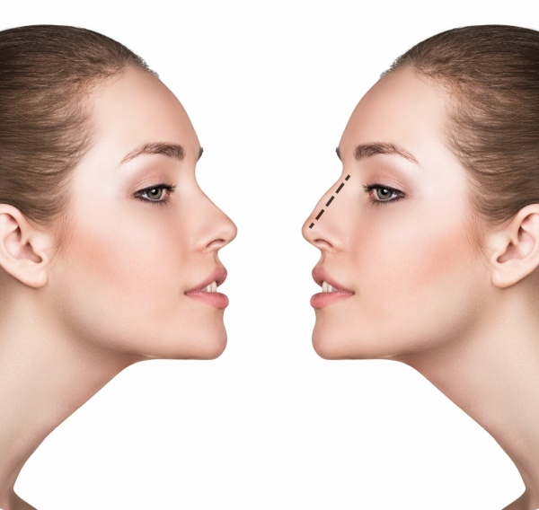 3 razones para someterse a una cirugía de nariz y cuándo no hacerlo