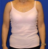 https://www.doctorangelchik.com/wp-content/uploads/2019/01/ba-brachioplasty-p1-a1.jpg