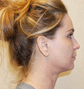 https://www.doctorangelchik.com/wp-content/uploads/2019/12/Angelchik_Glendale-Facial-Rejuvenation-FR1-Right-LAT-After.jpg