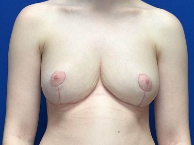 https://www.doctorangelchik.com/wp-content/uploads/2023/04/breast-reduction-after-13.jpeg