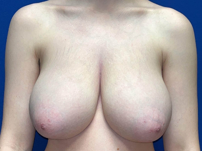 https://www.doctorangelchik.com/wp-content/uploads/2023/04/breast-reduction-before-13.jpeg
